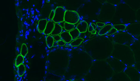 Human FSHD muscle cells